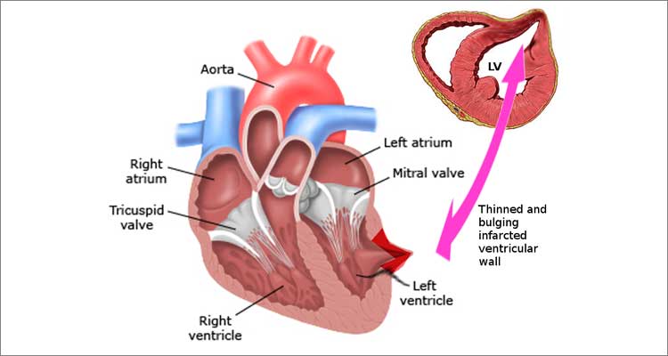 Cabg With Lv Aneurysmectomy Surgery Diagram
