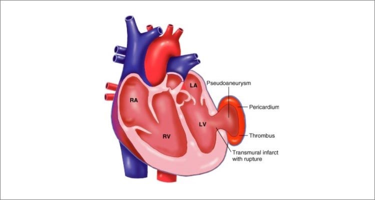 Aneurysm Operation Diagram