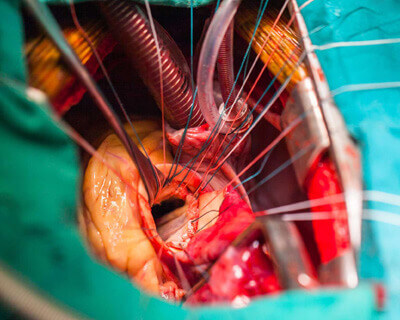 Top Cardiac Surgeon