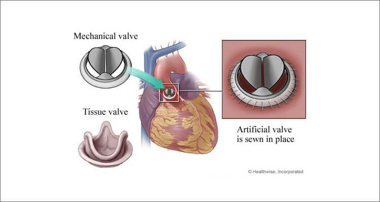 Aortic valve replacement