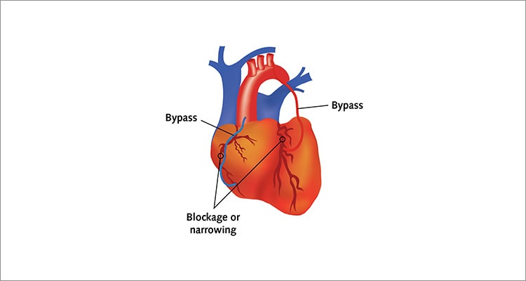 Arterial Type Coronary Artery Bypass Surgery