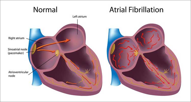 Atrial Fibrillation Diagram