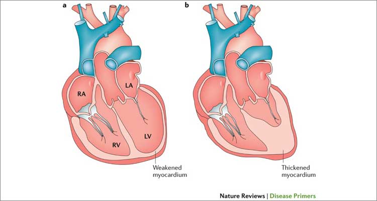 Cabg In Poor Ejection Fraction Diagram