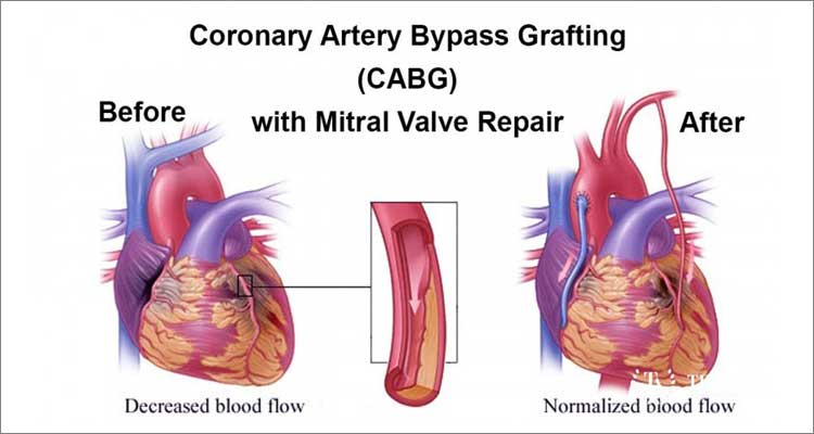 CABG with valve replacement