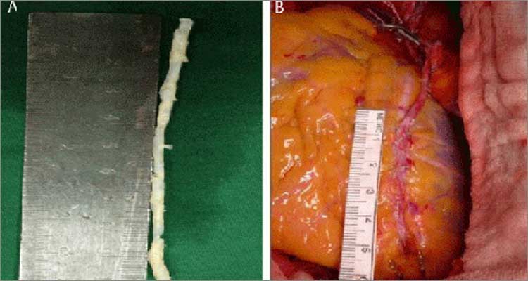 Coronary Endarterectomy