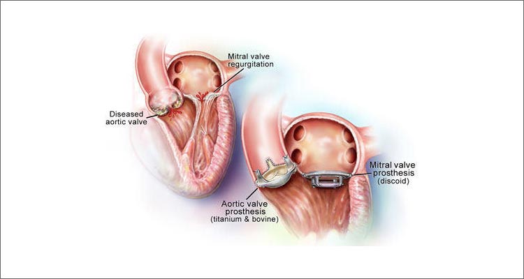 Heart Valve Surgeries