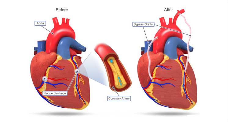 Minimally Invasive Cabg Diagram