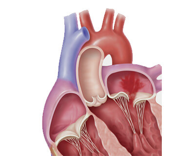 Mitral Valve Replacement