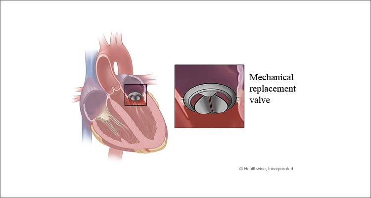 Mechanical Replacement Valve Diagram