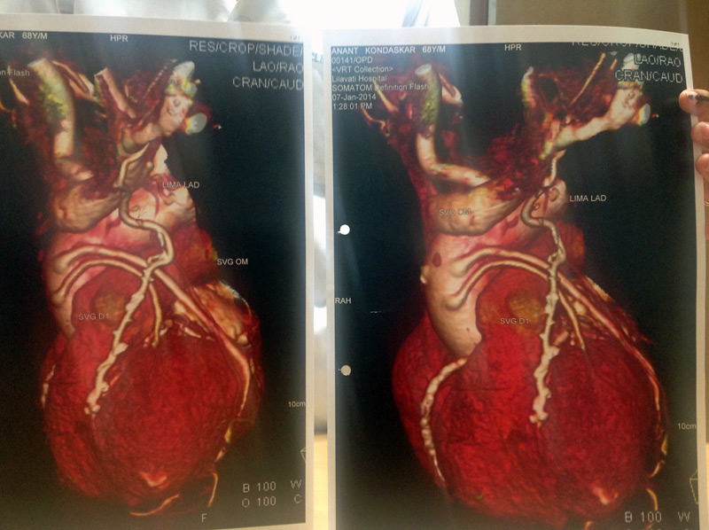 Long Term results  - follow up more than 10 years